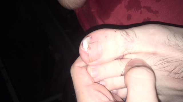 My injured toe on Koh Phangan